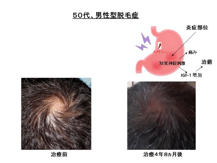 円形脱毛症　病院